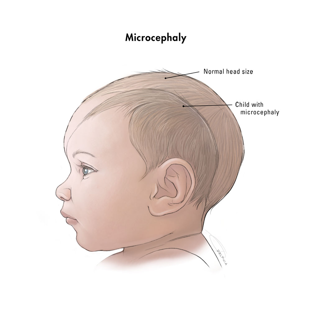 microcephaly newborn